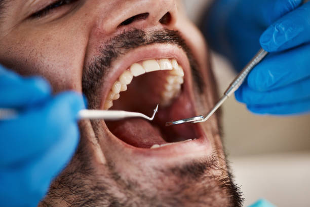 Best Emergency Dental Care for Broken or Chipped Teeth in Riner, VA